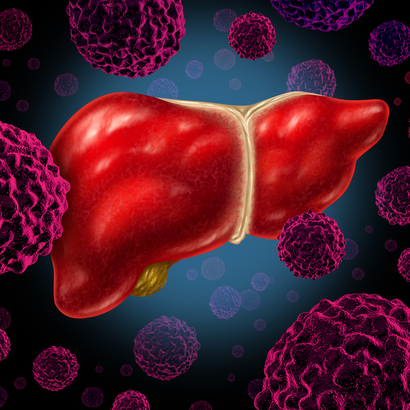 Human liver cancer organ as a medical symbol of a malignant tumor red cell disease as a cancerous growth spreading through the digestive system by alcohol and other environmental toxic reasons.